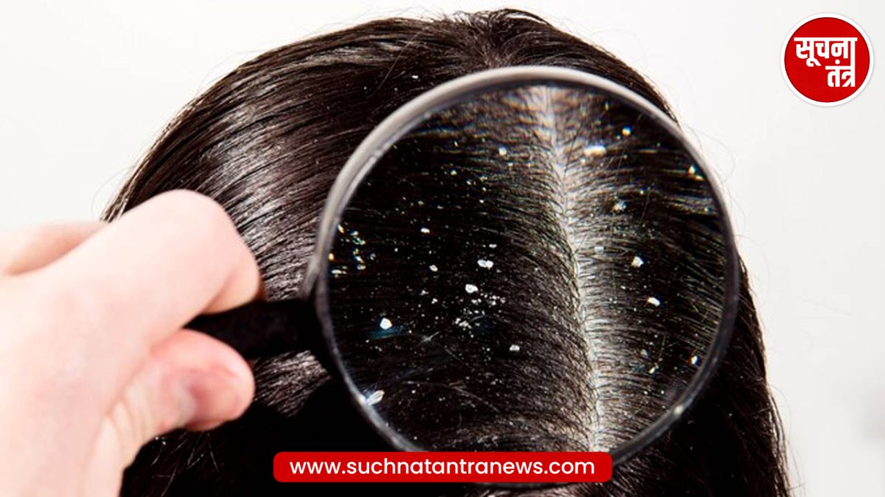 सर्दियां आते ही बालों में दिखने लगता है Dandruff ? जानिए आसान घरेलू उपाय जो करेंगे जड़ से खत्म